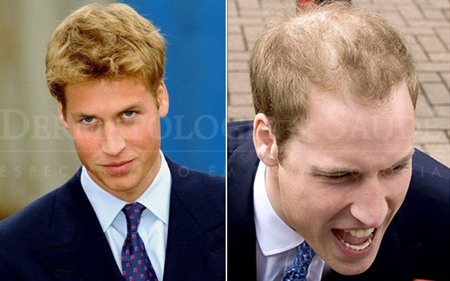 A calvície do Príncipe