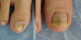 Micose da Unha Der