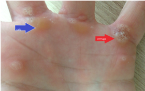 Bolinha na Pele da Criança é Verruga