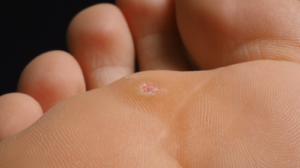 nem toda bolinha na pele de criança é verruga