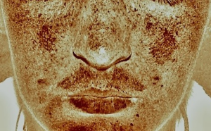 zmelasma