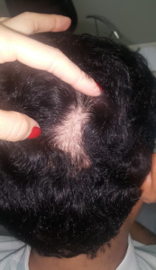 zalopeciaareata