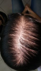 zalopeciandrogenetica