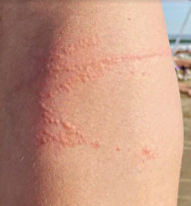 Lesão típica de queimadura por água viva na perna.