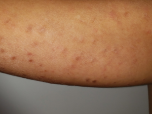 Pitiríase liquenóide: pequenas pápulas e manchas avermelhadas com leve descamação em braço.