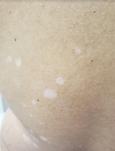 Pitiríase versicolor: manchas acastanhadas e descamativas em tronco, pescoço e braços.