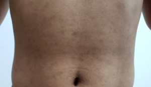 Dermatose cinzenta: Máculas castanho azuladas distribuídas simetricamente em áreas protegidas da exposição solar.