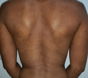 Dermatose cinzenta: máculas acinzentadas de distribuição simétrica em dorso.