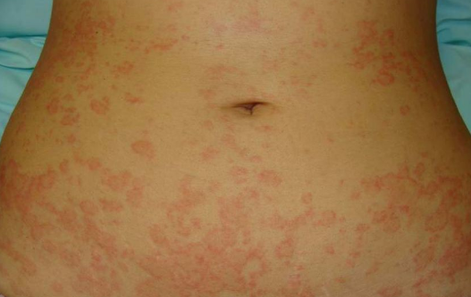 Pitiríase rósea de Gibert: lesões ovaladas, avermelhadas e com descamação na superfície